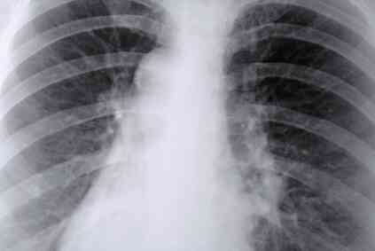 pulmones tratamiento lungs