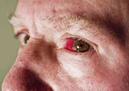 ¿Por qué los Vasos Sanguíneos estallan en los Ojos?