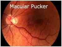 ¿Qué Es Pucker Macular?