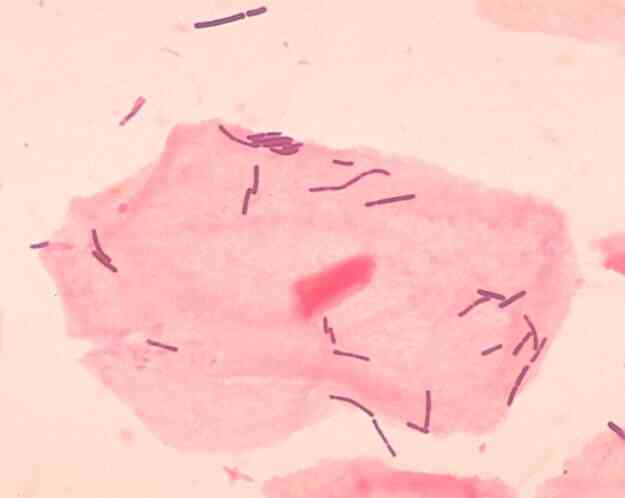 Es La Vaginosis Bacteriana Contagiosa?