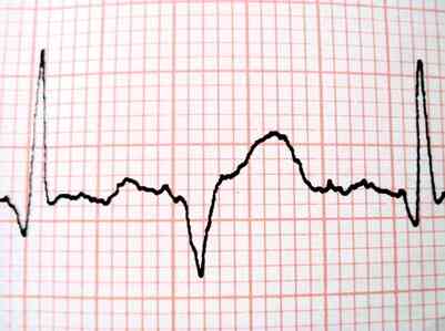 ¿Cuáles Son las Cuatro Partes de la Máquina de EKG?