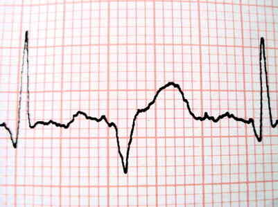La Diferencia Entre un electrocardiograma (EKG) & un Ecocardiograma