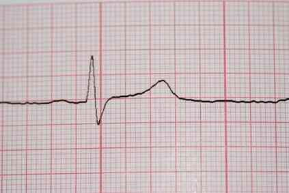 Cómo Calcular un Intervalo QT