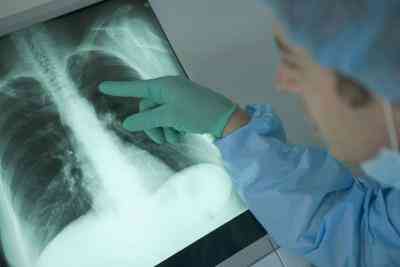 Lo que Hace que el Agua en los Pulmones?