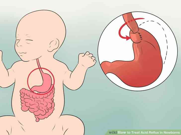 Imagen titulada el Tratamiento de Reflujo Ácido en los bebés recién Nacidos Paso 11