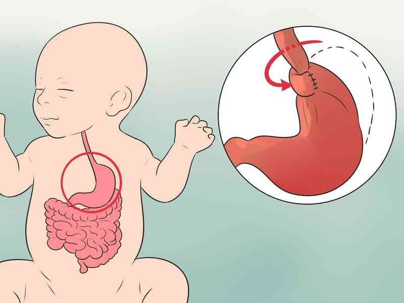 Cómo Tratar el Reflujo Ácido en los bebés recién Nacidos