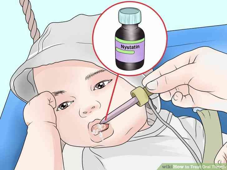 Como Tratar La Candidiasis Oral